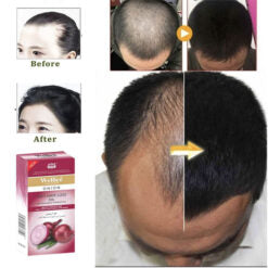 Wellice Onion Anti Hair Loss Shampoo and Hair Oil